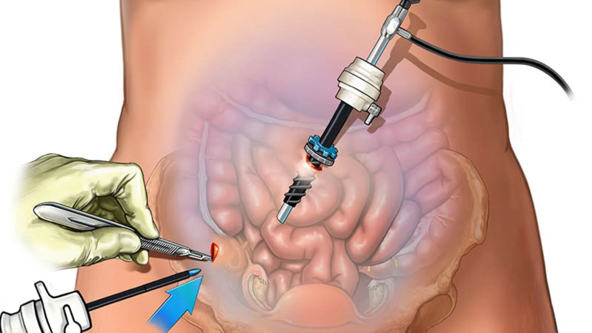Endometriosis Surgery