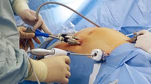 Hysteroscopic Surgery