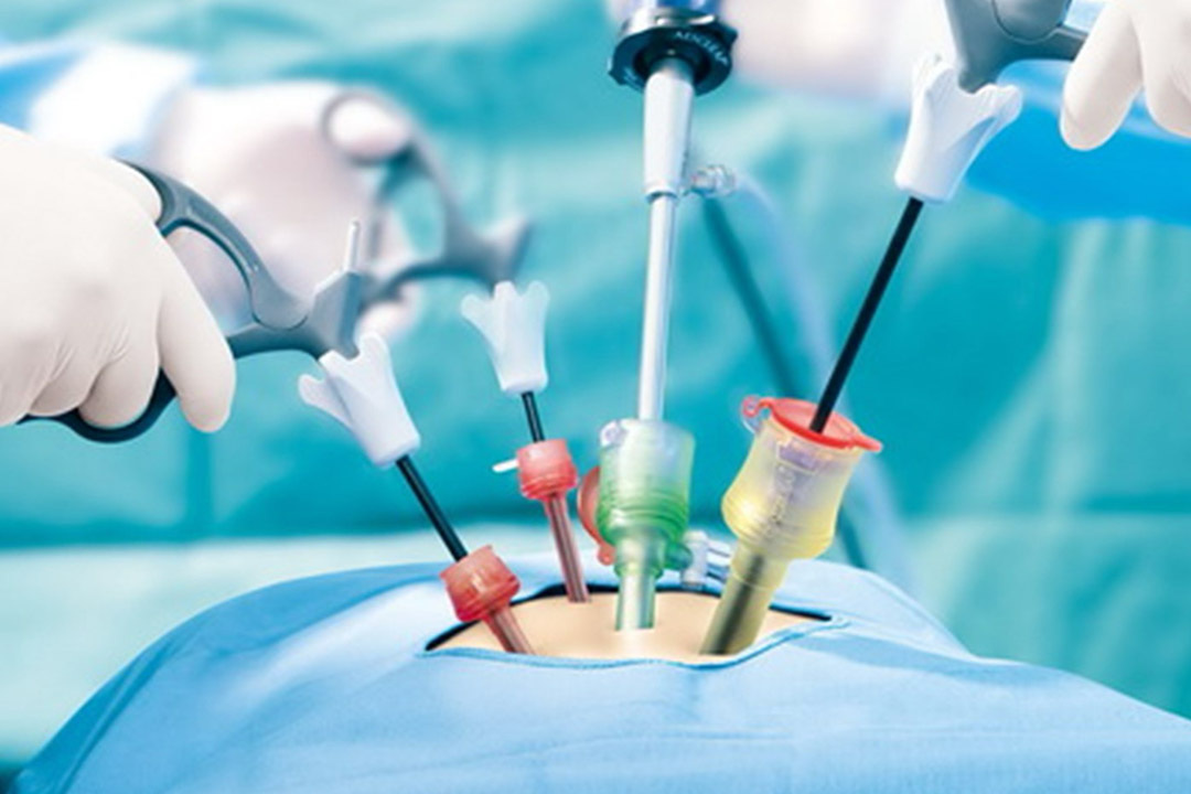 Tubal Blockage Surgery