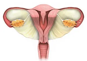 Uterine Septum Correction Surgery