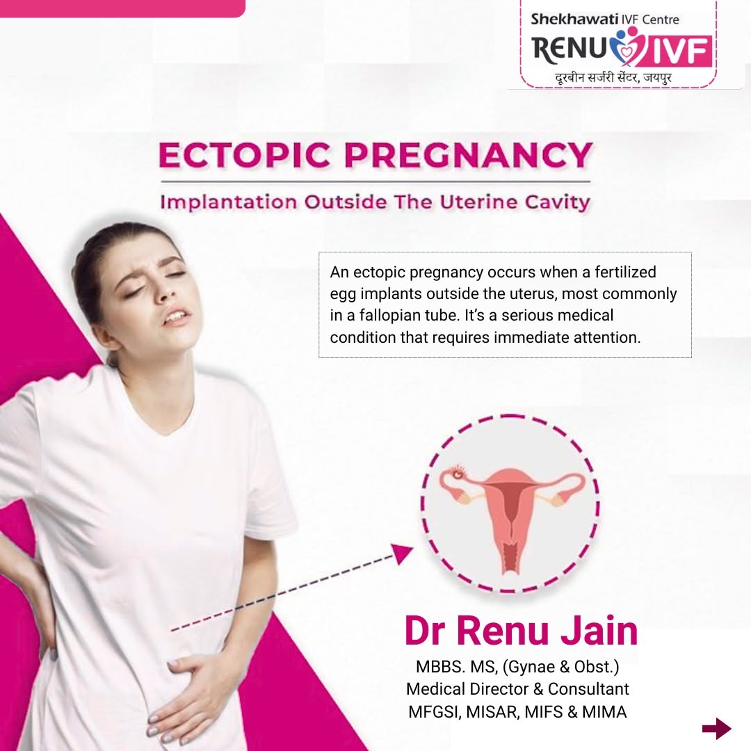 Ectopic Pregnancy